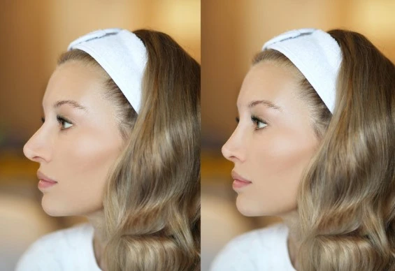 El Antes y después de una Rinoplastia en Pasto