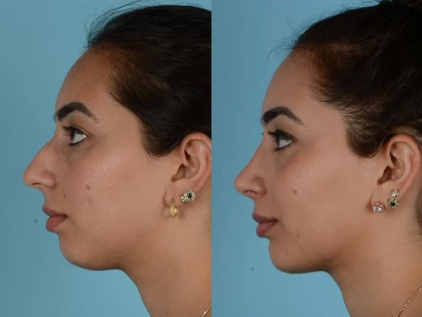 El antes y después de una rinoplastia en Bucaramanga
