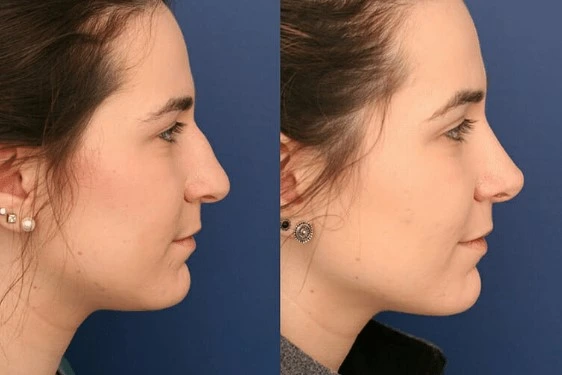 El antes y después de una rinoplastia en Bogota