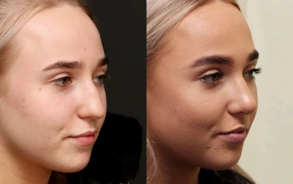 El antes y después de una rinoplastia en Cúcuta