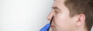 Todo lo que debe saber sobre el precio de la rinoplastia en Medellin