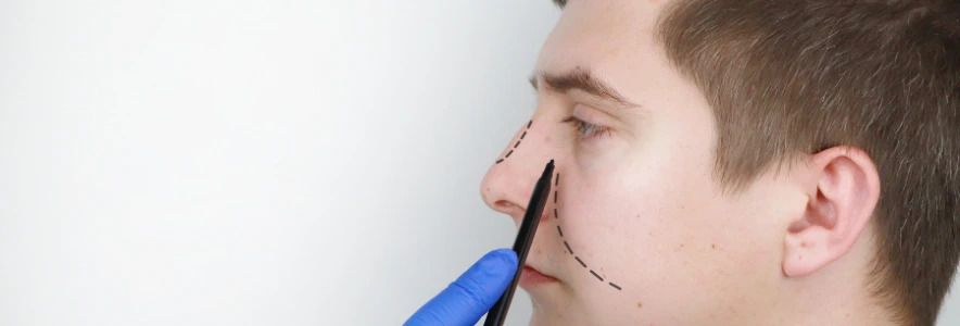 Todo lo que debe saber sobre el precio de la rinoplastia en Medellin