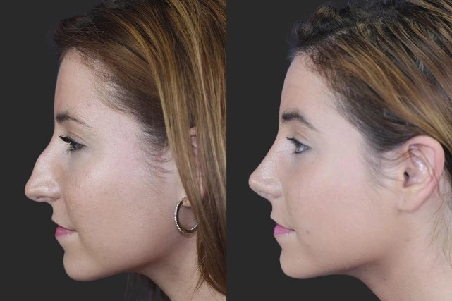Ejemplo del antes y después de una rinoplastia ultrasónica 