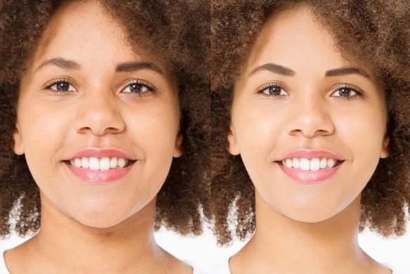 El Antes y después de una Rinoplastia en Pasto