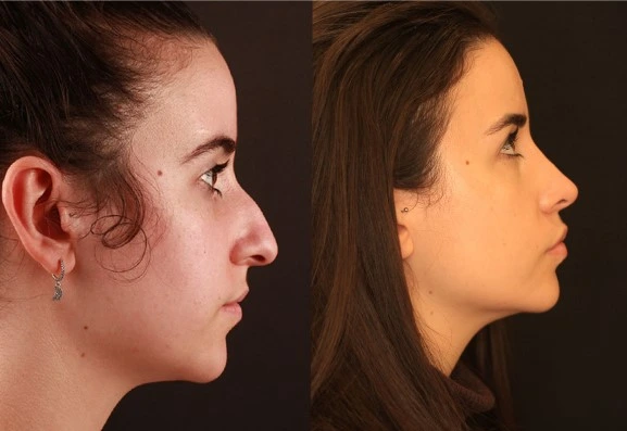 El antes y después de una rinoplastia en Cartagena