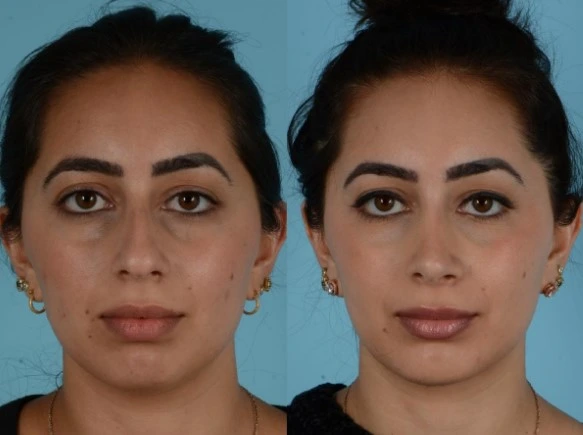 El antes y después de una rinoplastia en Manizales