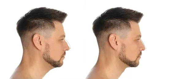 Rinoplastia en Medellín - Antes y Después